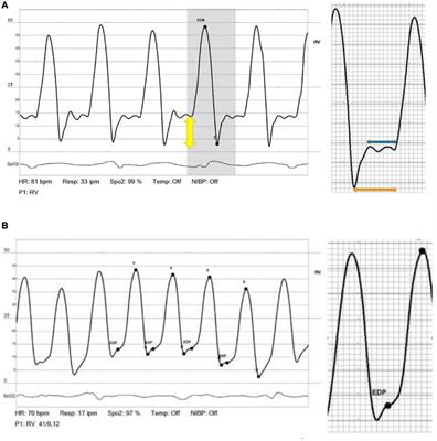 Diastolic Plateau – Invasive Hemodynamic Marker of Adverse Outcome Among Left Ventricular Assist Device Patients